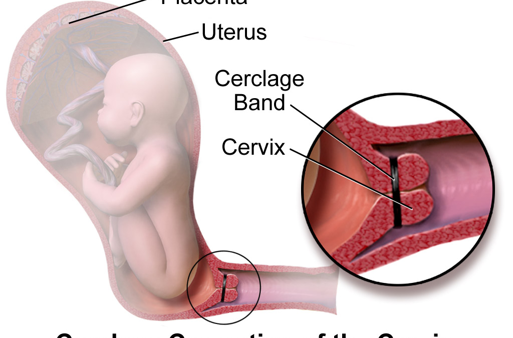 Cervical Cerclage – “Cervical Stitch”